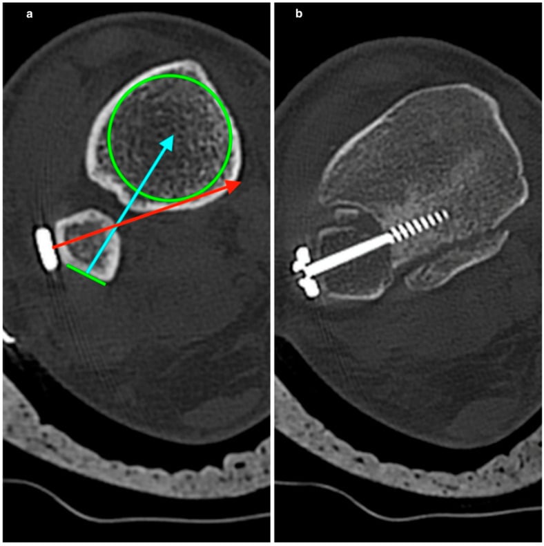 Axial CT showing posterior fibular translation caused by poor syndesmotic screw trajectory
