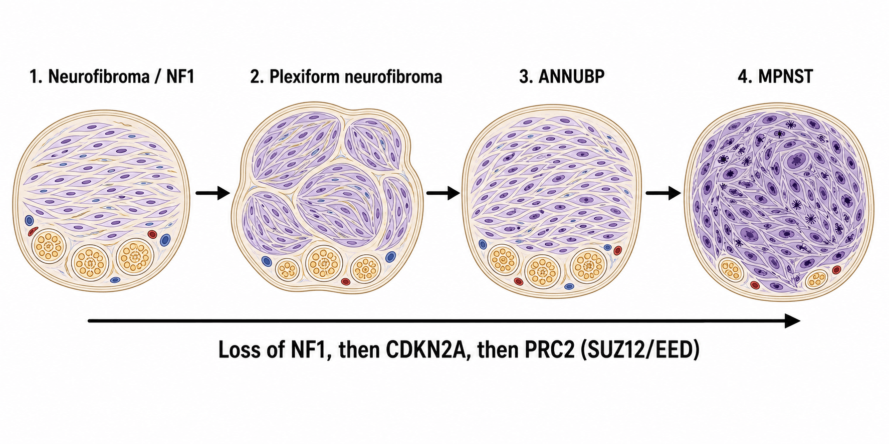 Diagram of the stepwise transformation from neurofibroma to plexiform neurofibroma to ANNUBP to MPNST with the underlying molecular hits