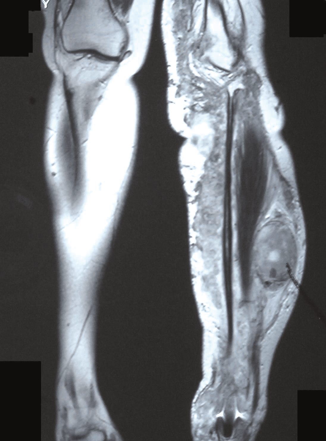 Coronal MRI of the leg showing a large heterogeneous soft-tissue mass, a malignant peripheral nerve sheath tumour