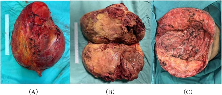 Gross MPNST specimen before and after sectioning, with the operative cavity shown in the final panel.