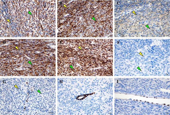 Immunohistochemistry showing S100 negativity and loss of H3K27me3 in MPNST, with retained internal controls.