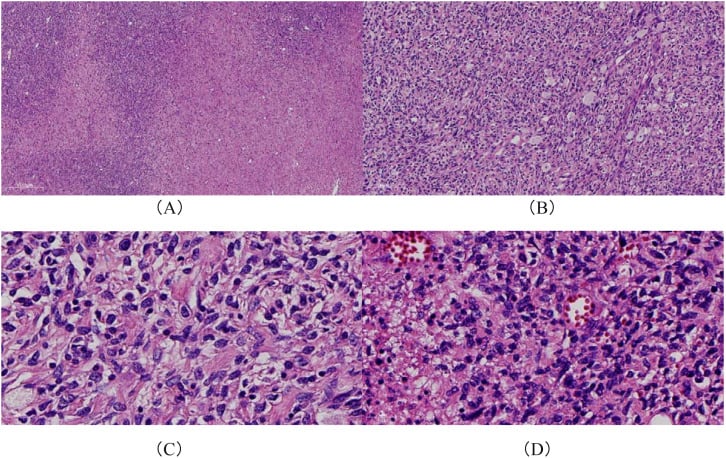 H&E histology of high-grade MPNST showing map-like hypercellularity, fascicles and nuclear atypia.