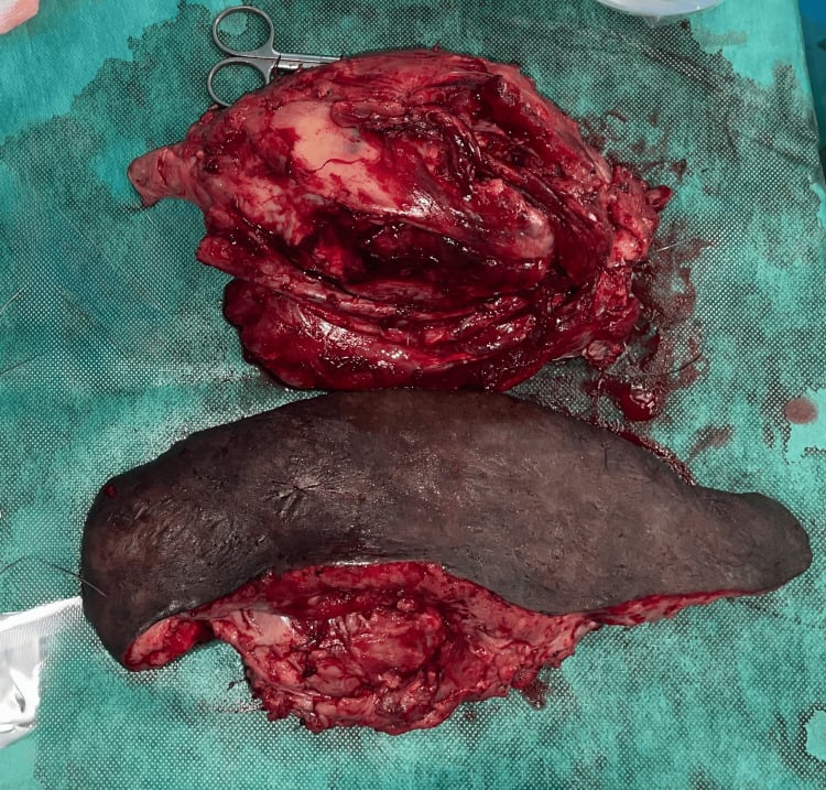 Operative MPNST specimen with separately excised neurofibromatous skin.