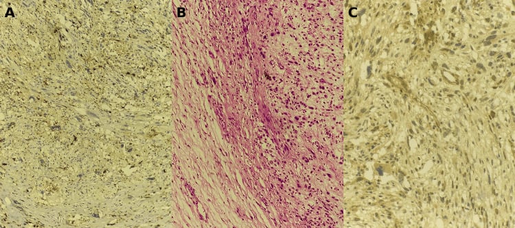 Histopathology and immunohistochemistry of MPNST showing patchy S100 and SOX10 expression.