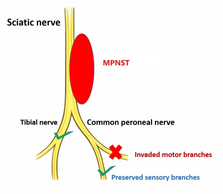 Schematic showing involved motor-branch excision and preservation of uninvolved sensory branches in MPNST surgery.