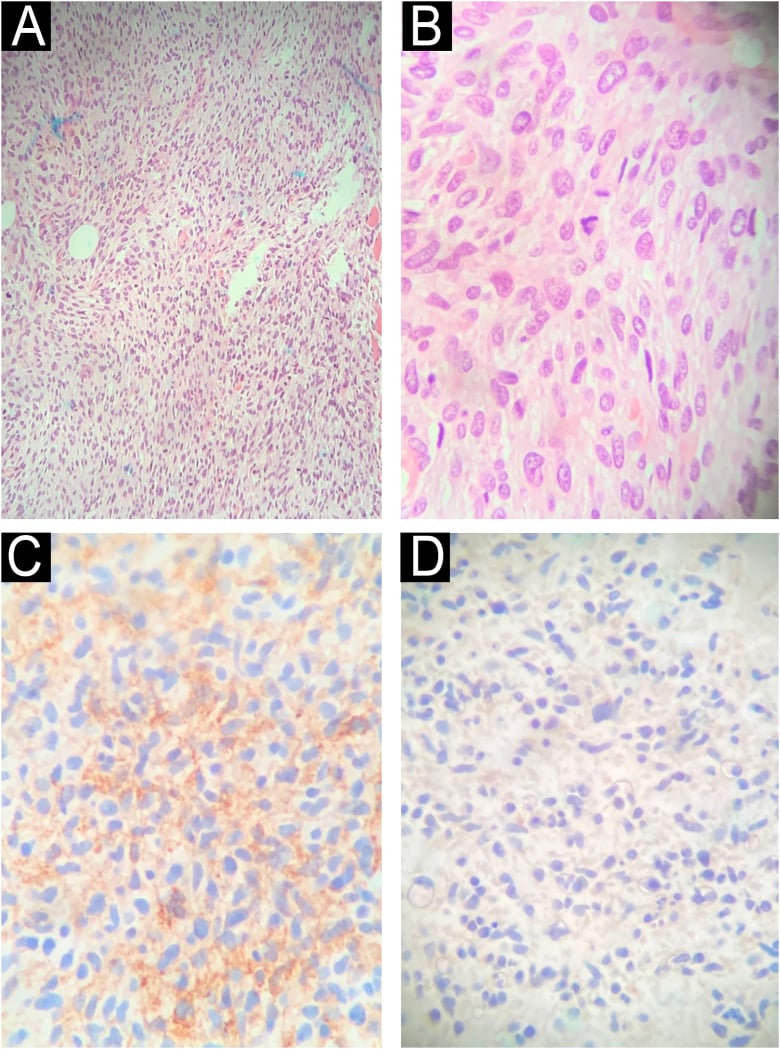 H&E and immunohistochemistry from a spindle-cell MPNST specimen after hip disarticulation.