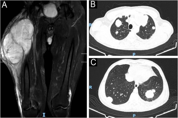 MRI of a large thigh MPNST paired with chest CT showing pulmonary metastases.