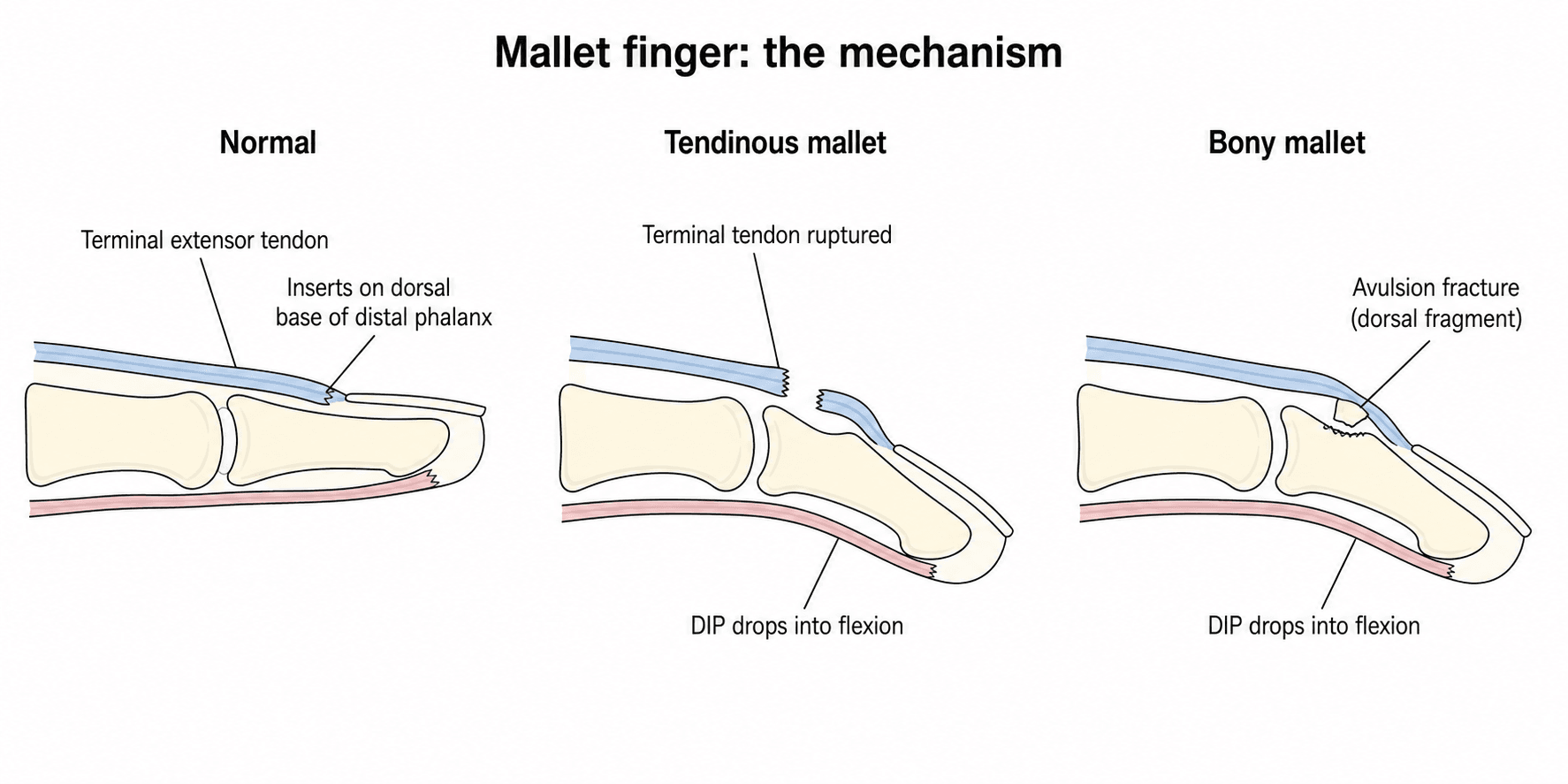 Three-panel sagittal schematic of the mallet-finger mechanism: normal terminal extensor tendon insertion, tendinous mallet (tendon ruptured), and bony mallet (dorsal avulsion fragment), each with the DIP dropping into flexion.