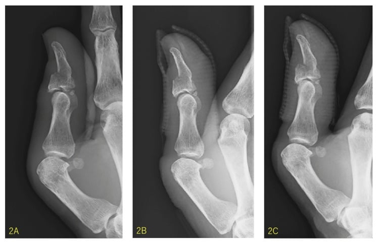 Serial thumb radiographs showing a dorsal intra-articular distal-phalanx fragment before and after closed reduction