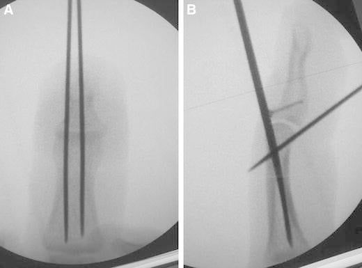 Fluoroscopic views of paired extension-block wires and microscrew fixation for a bony mallet fracture