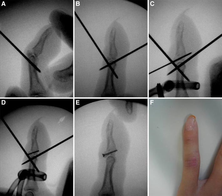 Stepwise fluoroscopic sequence of extension and flexion block wires drill-hole preparation microscrew insertion and wire removal