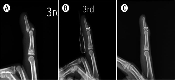 Serial lateral radiographs of a subluxed bony mallet fracture before hook-plate fixation after reduction and at union