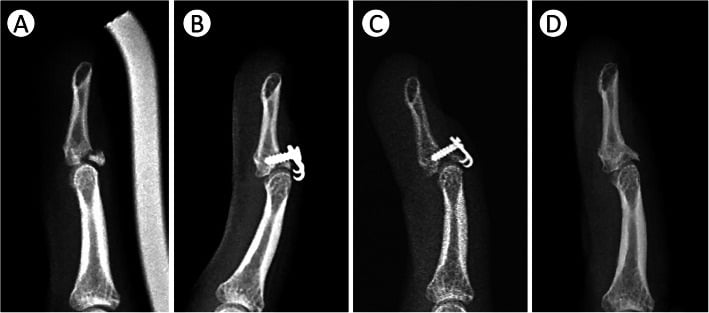 Serial lateral radiographs showing poor hook-plate screw purchase implant loosening fragment displacement and later union