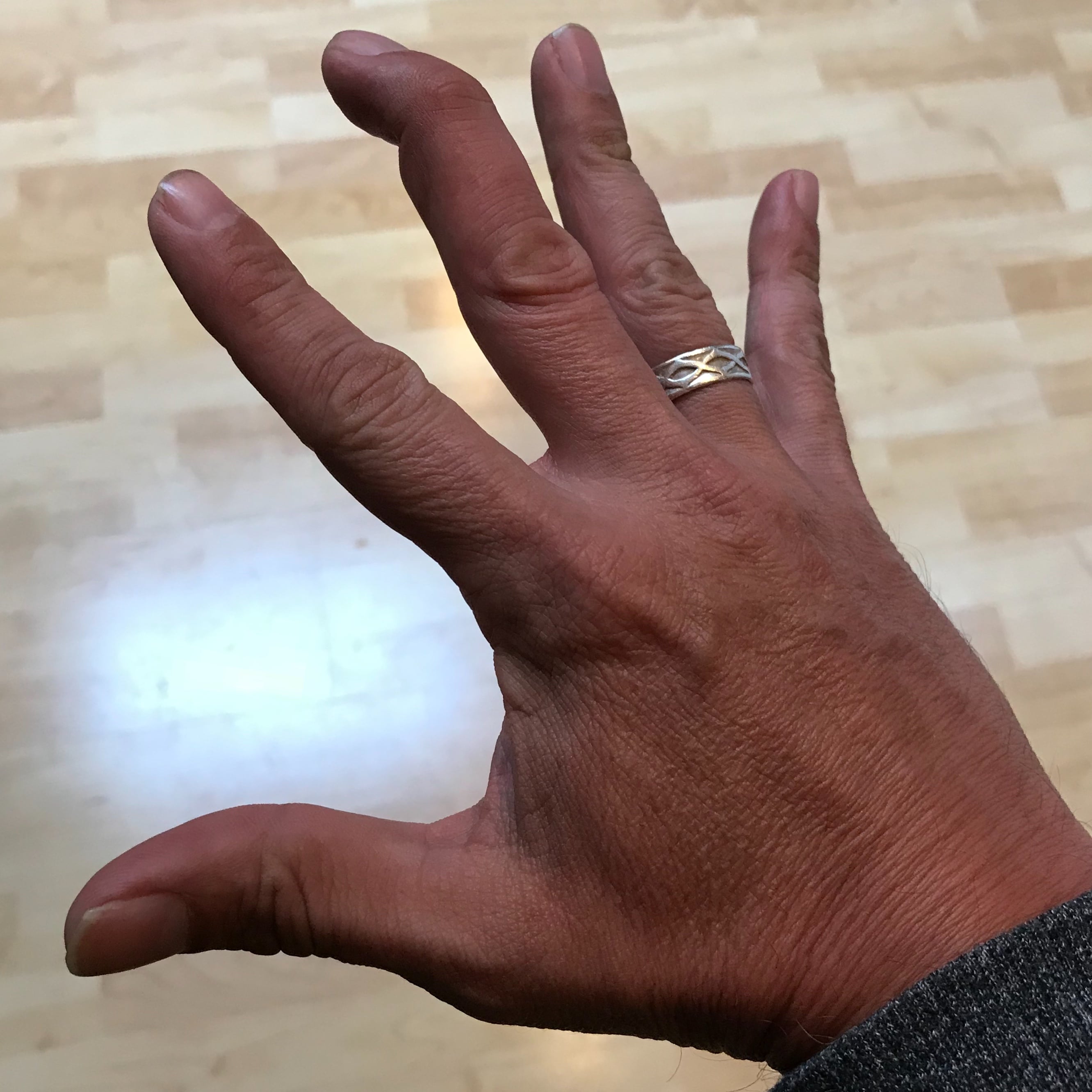 Clinical photograph of a mallet finger: the middle finger droops at the distal interphalangeal joint and cannot be actively straightened