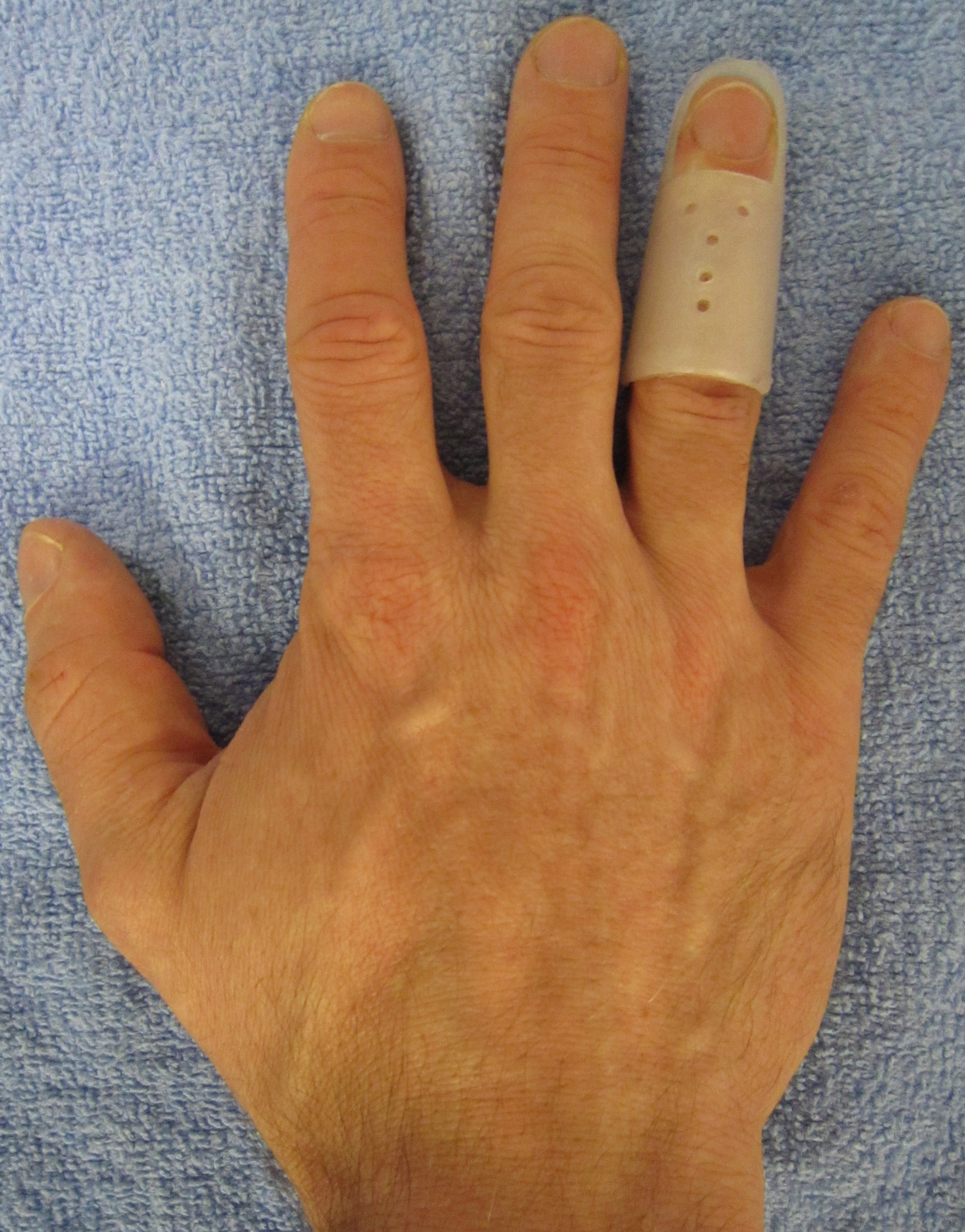 Stack-type extension splint applied to the distal interphalangeal joint for mallet finger