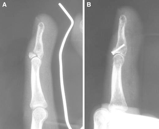 Lateral radiographs of a type IIB bony mallet fracture before and after anatomical reduction