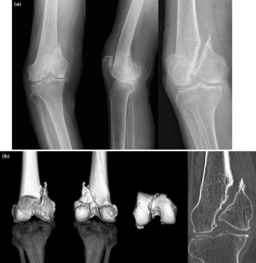 Multiple-view knee radiographs and CT reconstructions showing a medial femoral condyle fracture nonunion.
