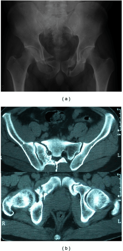 AP pelvic radiograph and axial CT images showing nonunion of the right sacrum and bilateral pubic rami.