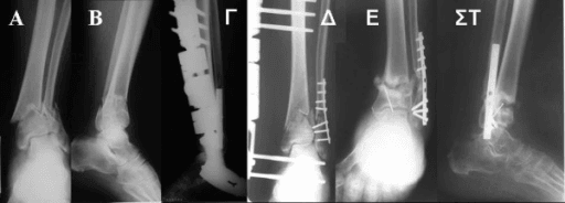 Preoperative and postoperative radiographs of a distal tibial fracture complicated by delayed union after fibula fixation.