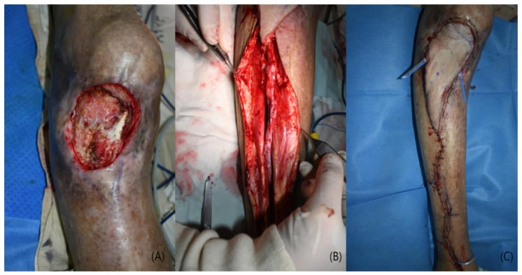 Debrided tibial defect, anterior tibial recipient-vessel preparation and immediate free-flap inset