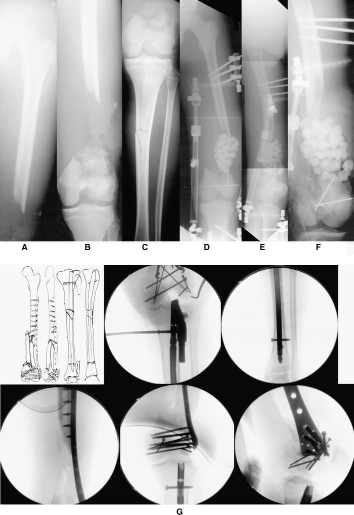 Serial radiographs of a type IIIC distal femoral and tibial injury through temporary fixation, bone reconstruction and definitive fixation