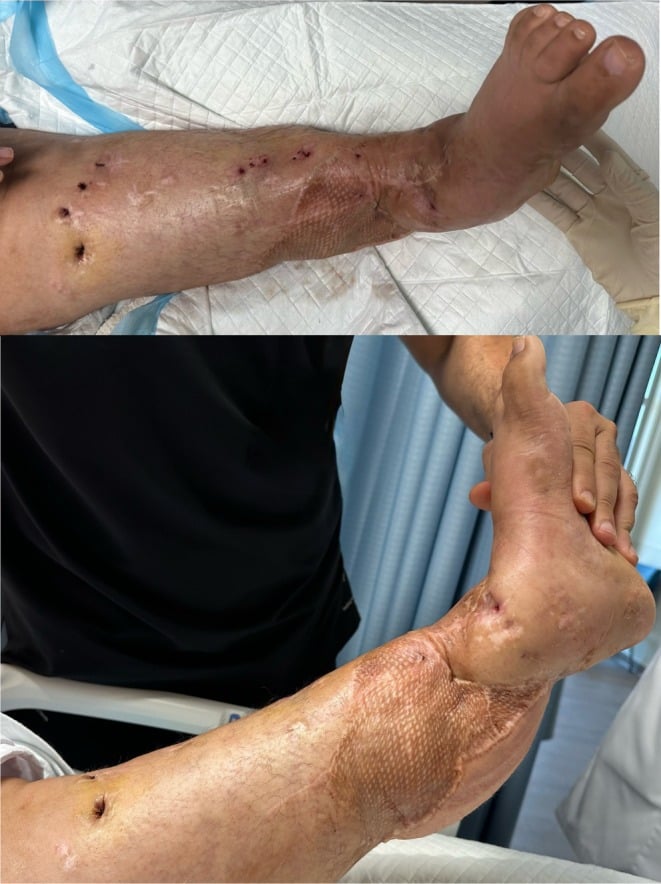 Healed distal lower-leg free flap eighteen months after mangled-limb reconstruction