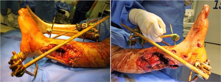 Near-amputation injury of the distal lower leg with partial skin continuity and temporary external fixation