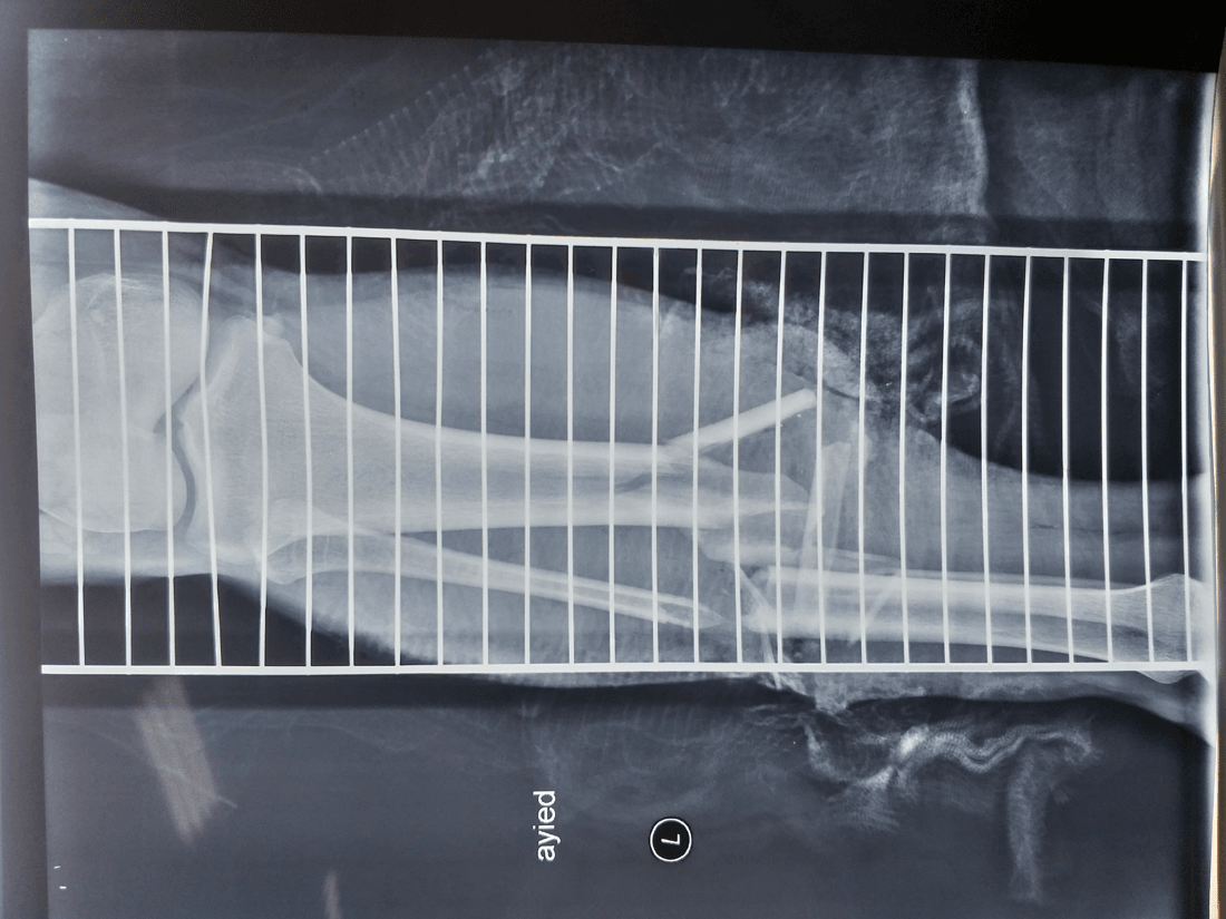 Radiograph of a displaced comminuted open tibial and fibular shaft fracture