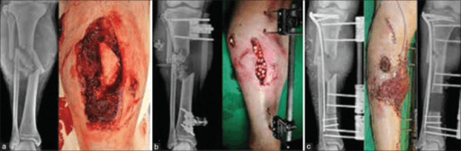Severe open tibial fracture sequence showing soft tissue loss, fixation and reconstruction