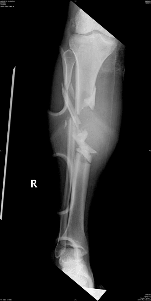 Severe open tibial fracture radiograph with segmental bone loss