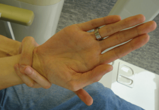 Positive Walker-Murdoch wrist sign in Marfan syndrome: thumb and little finger overlap when encircling the opposite wrist