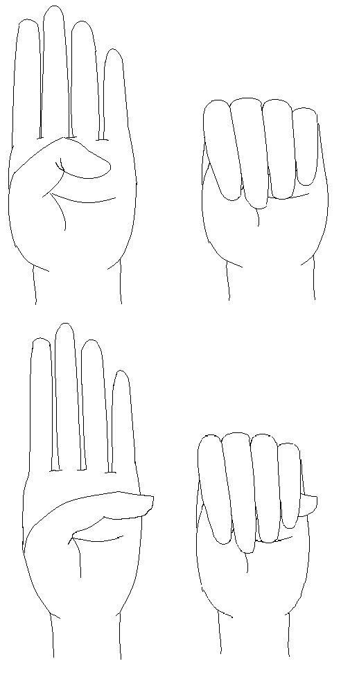 Diagram of Steinberg's thumb sign: a flexed thumb tucked into a clenched fist protrudes beyond the ulnar border of the hand