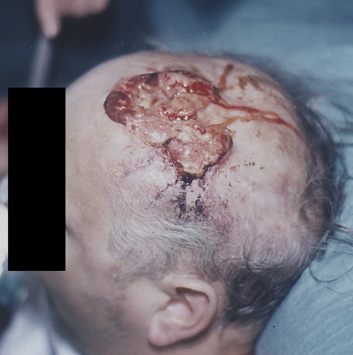 De-identified clinical photograph of a fungating, ulcerating Marjolin's ulcer on the scalp of an elderly patient.