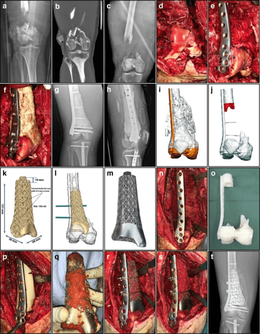 Anteroposterior radiograph and CT image of a distal femur with a large segmental bone defect.