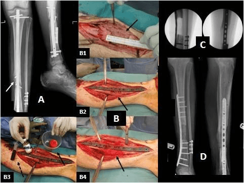 Anteroposterior and lateral radiographs of the tibia with an intramedullary nail and arrow marking osteolysis.