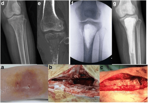 Clinical photograph of the left lower leg showing tenderness over an area of tibial osteomyelitis.