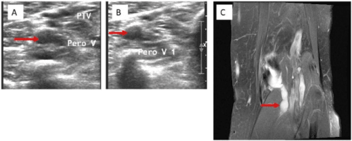 Two compression ultrasound images of the calf veins, the first showing a dilated echogenic peroneal vein marked by an arrow