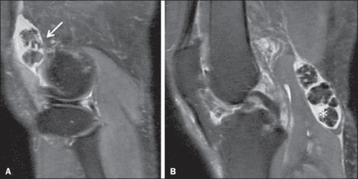 Sagittal MRI of the knee showing multiple small loose bodies in the suprapatellar and posterior recesses
