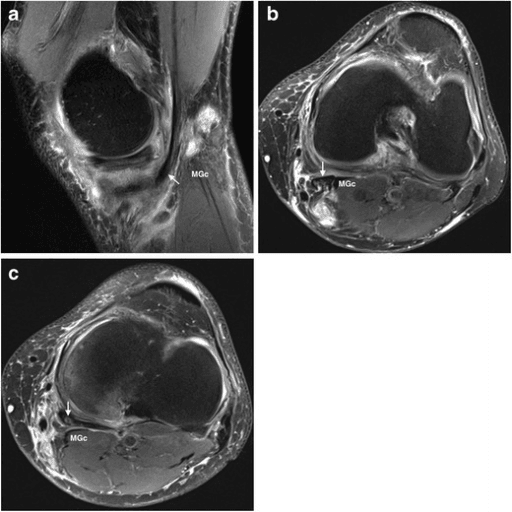 Sagittal MRI of the knee and calf showing a ruptured popliteal cyst with fluid tracking into surrounding soft tissue