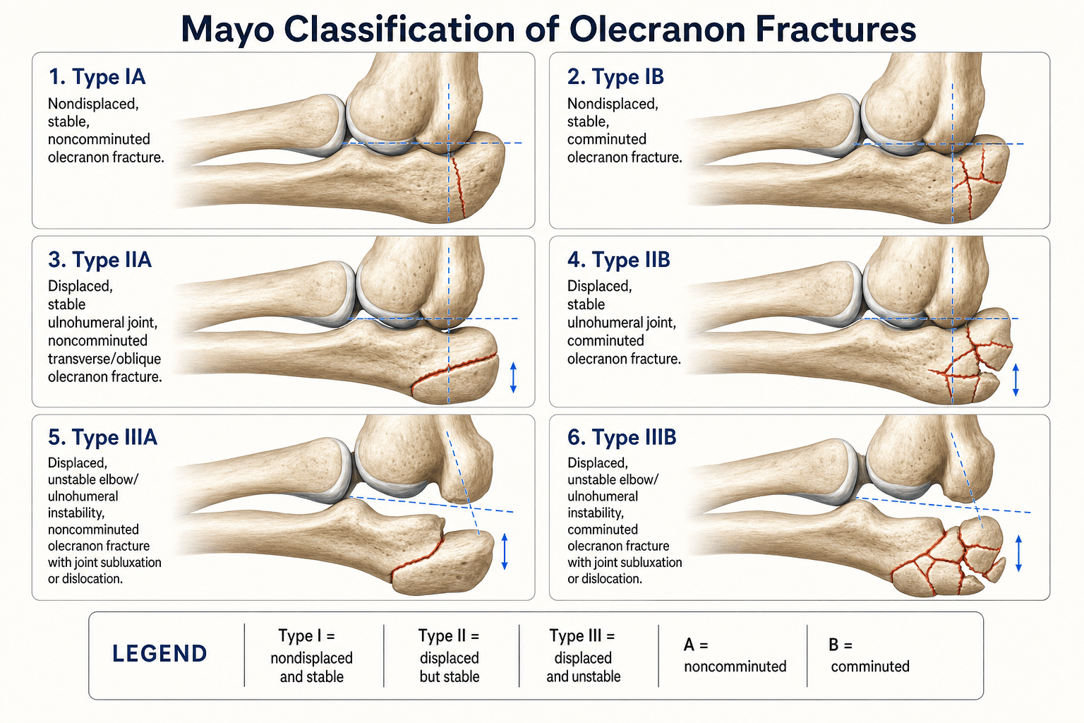 Mayo Classification of Olecranon Fractures