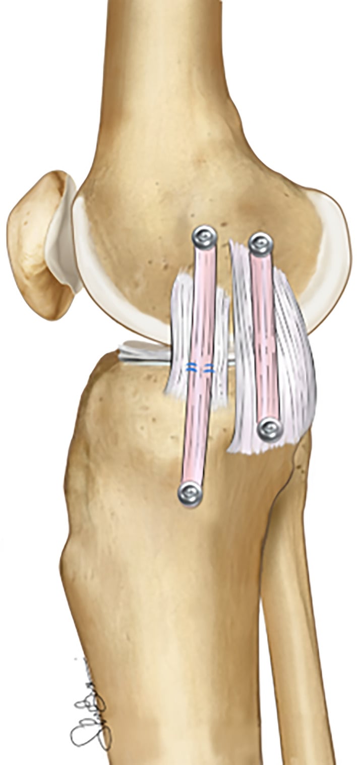 Medial knee illustration showing separate grafts reconstructing the superficial MCL and posterior oblique ligament at their anatomical footprints