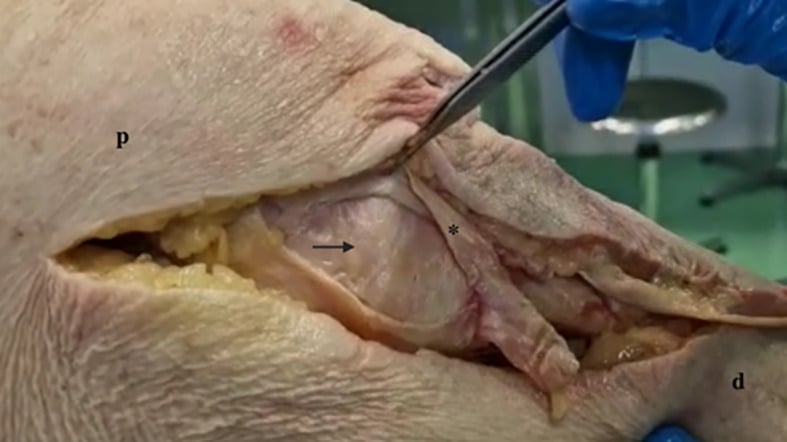 Cadaveric medial knee dissection with the superficial MCL reflected to expose the deep MCL and semimembranosus anterior arm