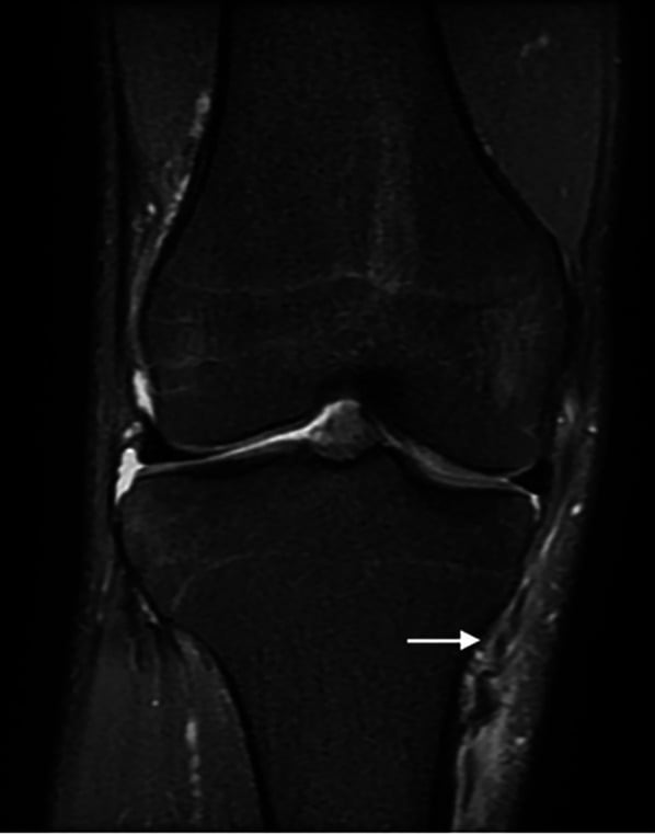 Coronal fluid-sensitive knee MRI with an arrow marking a distal superficial medial collateral ligament lesion