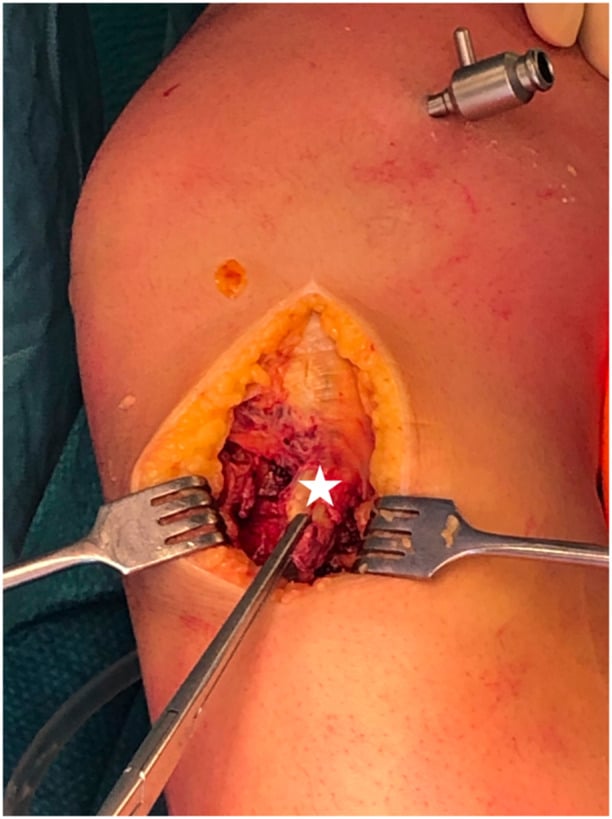 Intraoperative medial knee photograph showing distal MCL avulsion repair to the tibia with a suture anchor