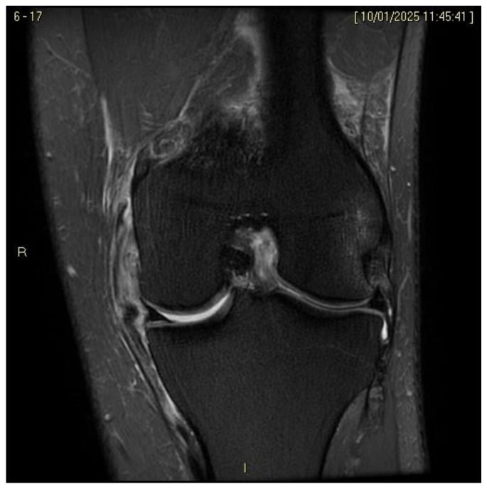 Coronal fluid-sensitive knee MRI showing complete proximal medial collateral ligament disruption in a combined ACL-MCL injury