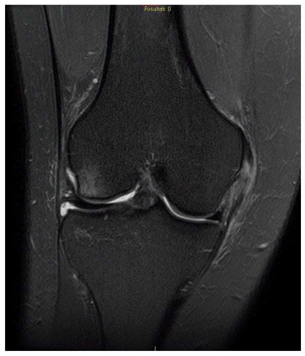 Coronal fluid-sensitive knee MRI showing a partial proximal medial collateral ligament tear with oedema but retained fibres