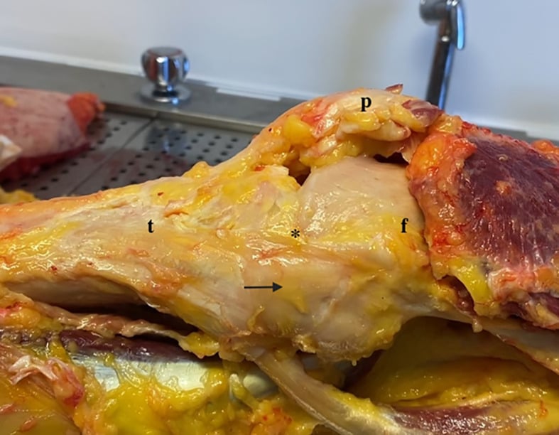 Cadaveric medial view of a knee in extension showing the superficial medial collateral ligament and posterior oblique ligament