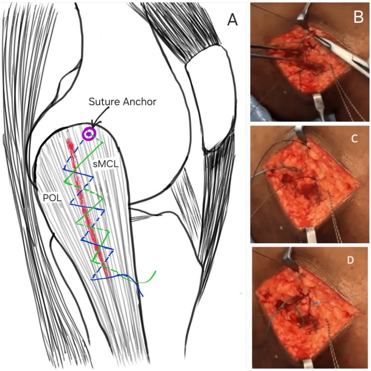 Schematic and operative sequence of acute superficial MCL and posterior oblique ligament shoelace repair with a femoral anchor