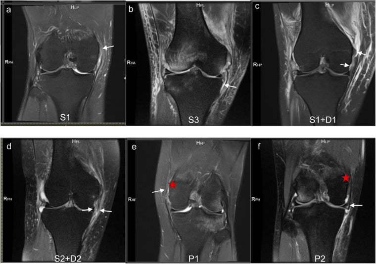 Six coronal fat-suppressed knee MRI panels showing superficial and deep MCL tears at femoral, joint-line and tibial locations