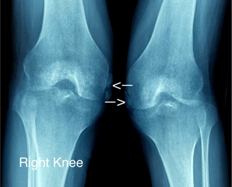 Bilateral AP knee radiographs showing ossification adjacent to both medial femoral condyles at the MCL origins